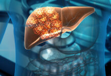 Alertan que los casos de cáncer de hígado se duplicarán en 2050