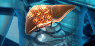 Alertan que los casos de cáncer de hígado se duplicarán en 2050