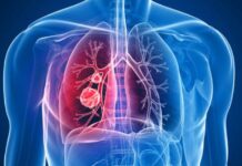 El cáncer de pulmón podría provocar la muerte de 160.000 latinoamericanos en 10 años