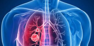 El cáncer de pulmón podría provocar la muerte de 160.000 latinoamericanos en 10 años