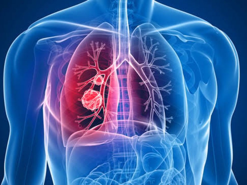 cancer-de-pulmon-podria-provocar-muerte-de-160000-latinoamericanos-454384